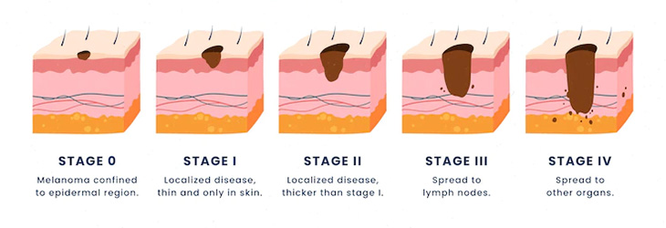 Cancer Grades and Cancer Stages